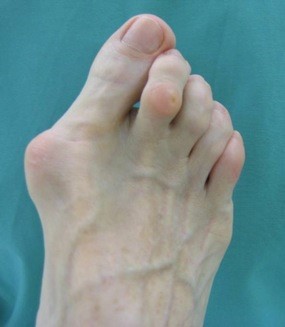 A patient with bunions on their feet