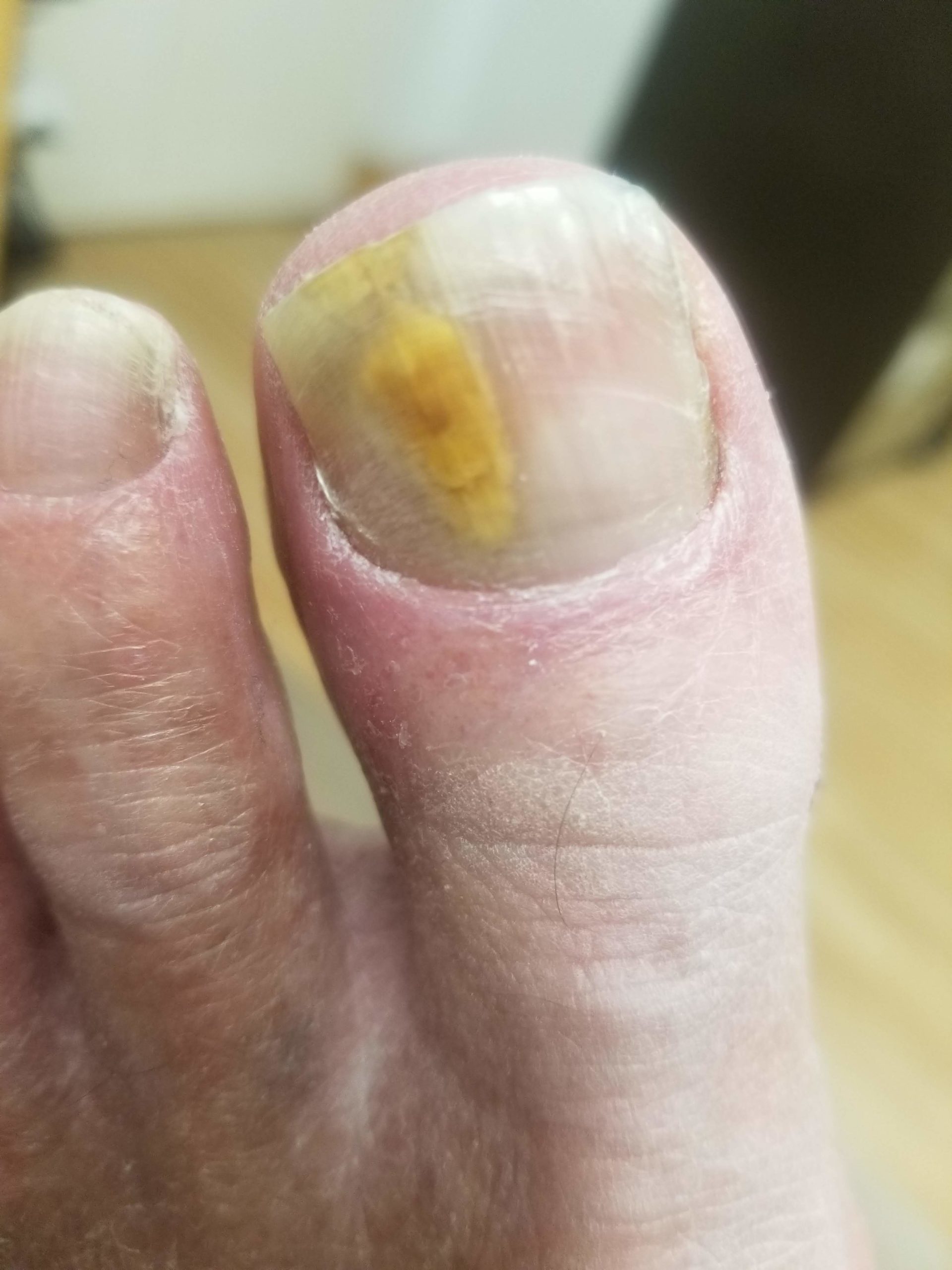 Fungal nail