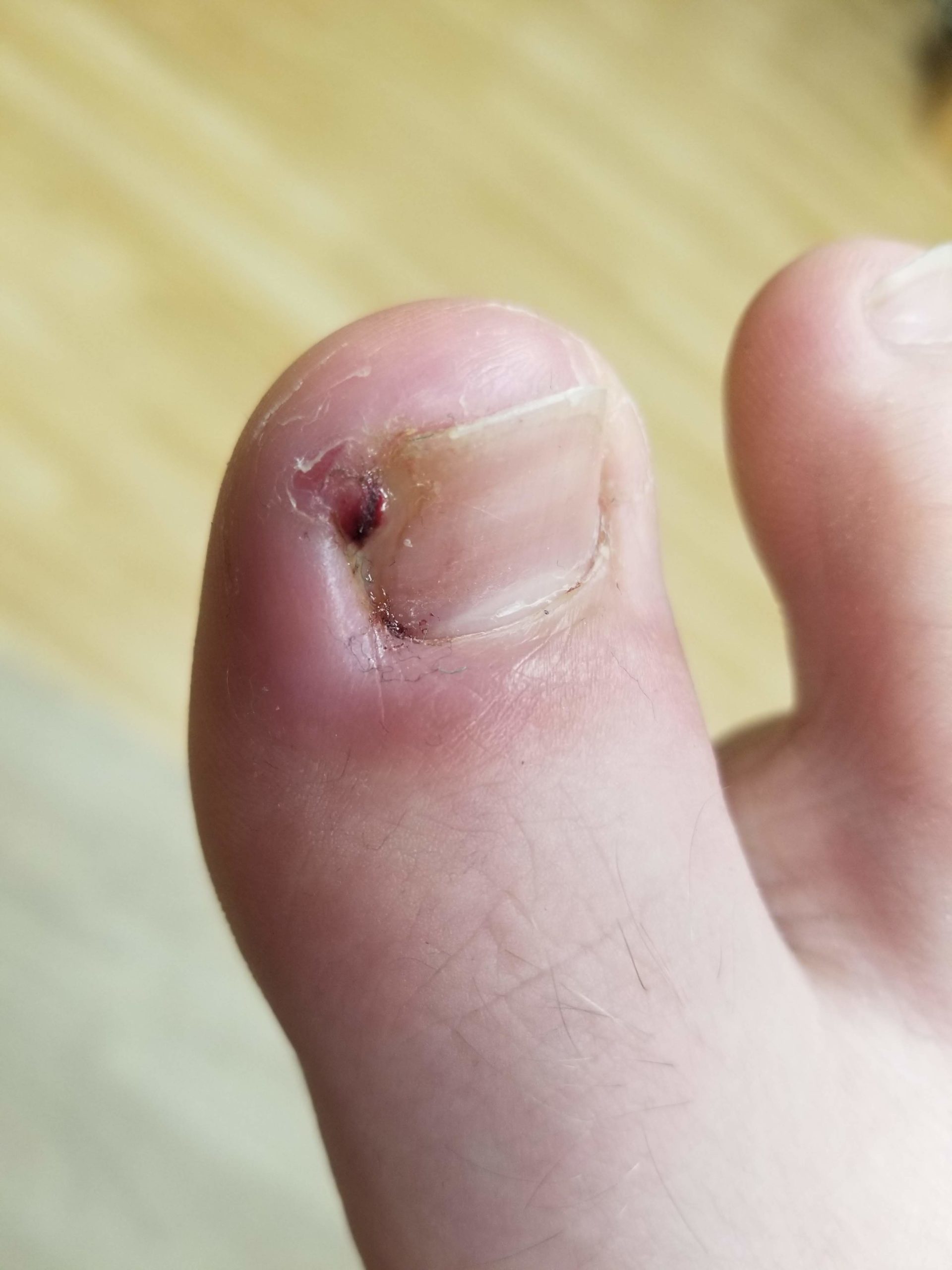Ingrowing toenail