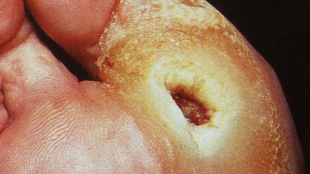 Diabetic neuropathic foot ulcer