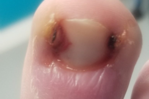 Ingrown Toenails