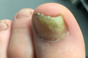 Fungal Nail