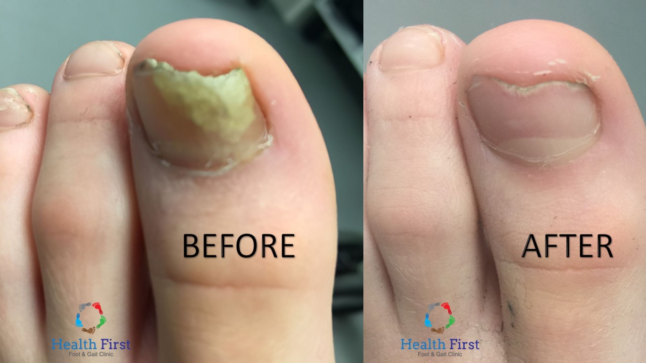 Fungal nails before and after